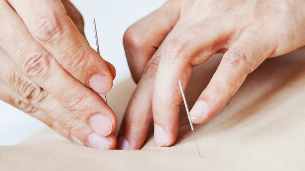 acupuntura