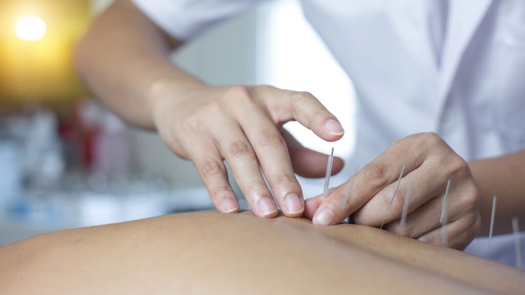 acupuntura