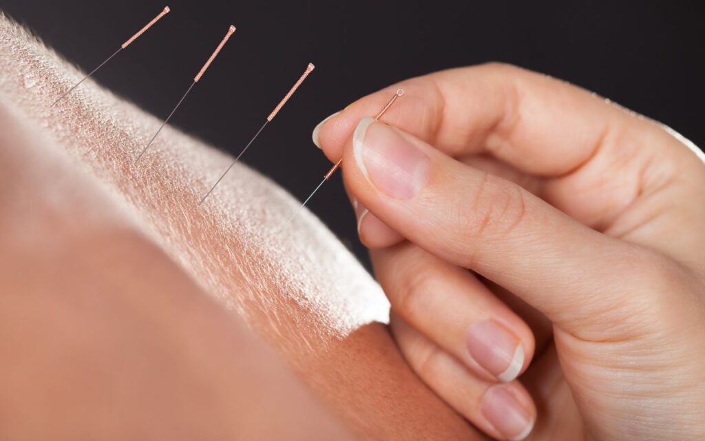 acupuntura